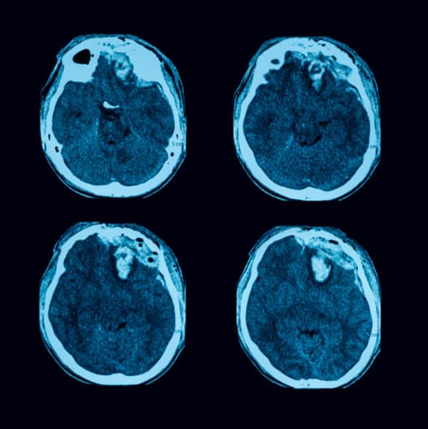 probst tbi